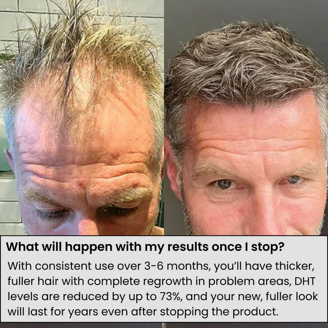 Innovex™ Hair Regrowth System